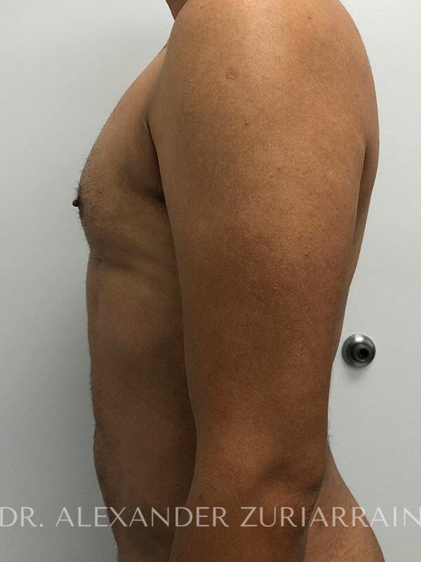 High definition liposuction before & after photo