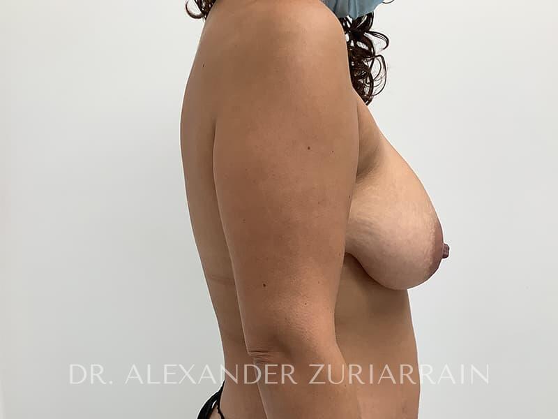 Breast lift before & after photo