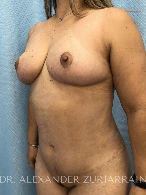 Nipple correction before & after photo
