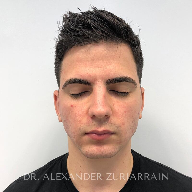 Otoplasty before & after photo