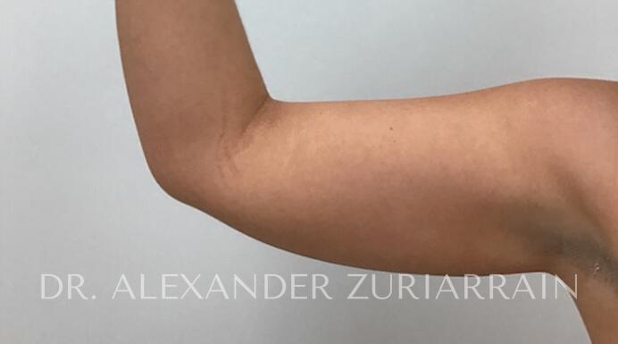 Arm liposuction before & after photo