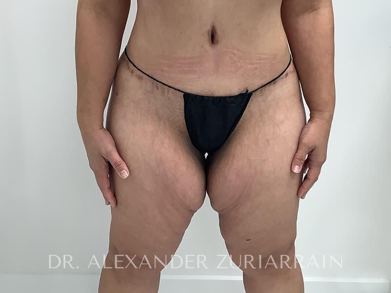 Thigh lift before & after photo