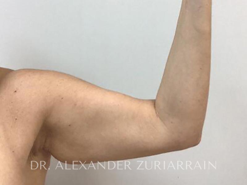 Arm lift before & after photo