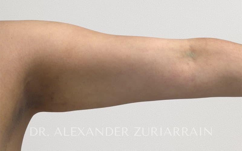 Arm liposuction before & after photo