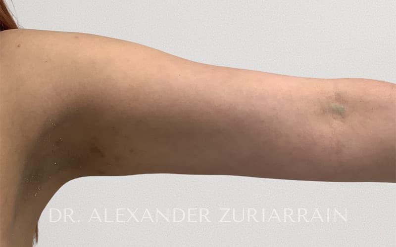 Arm liposuction before & after photo