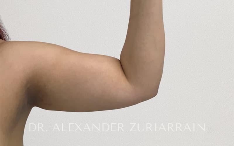 Arm liposuction before & after photo