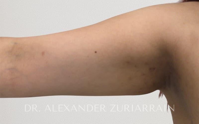 Arm liposuction before & after photo