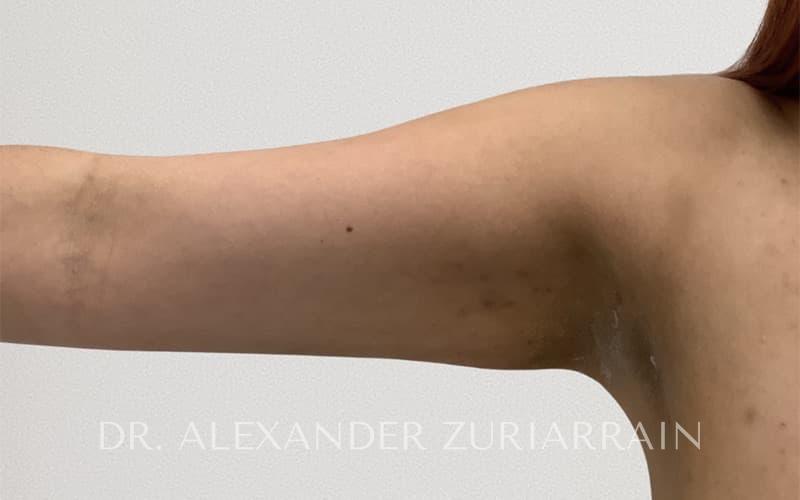 Arm liposuction before & after photo