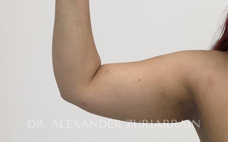 Arm liposuction before & after photo