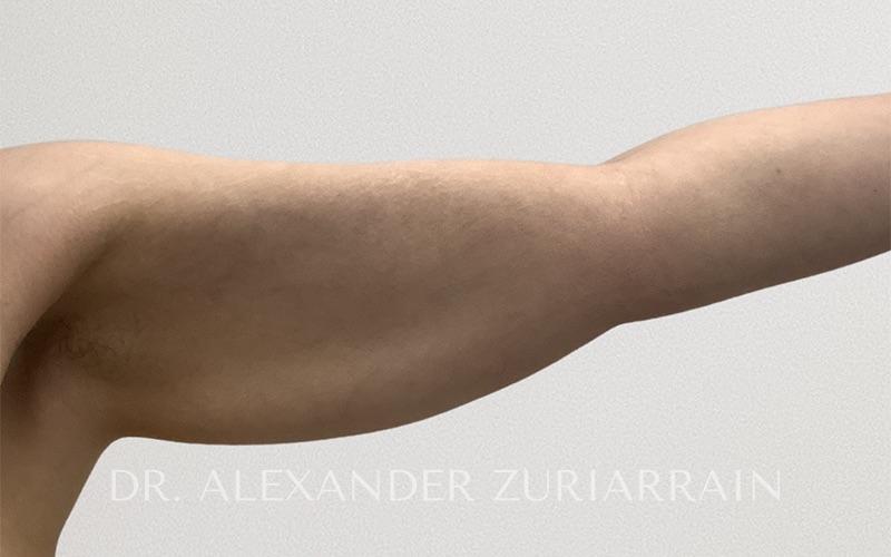 Arm liposuction before & after photo