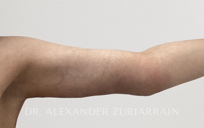 Arm liposuction before & after photo