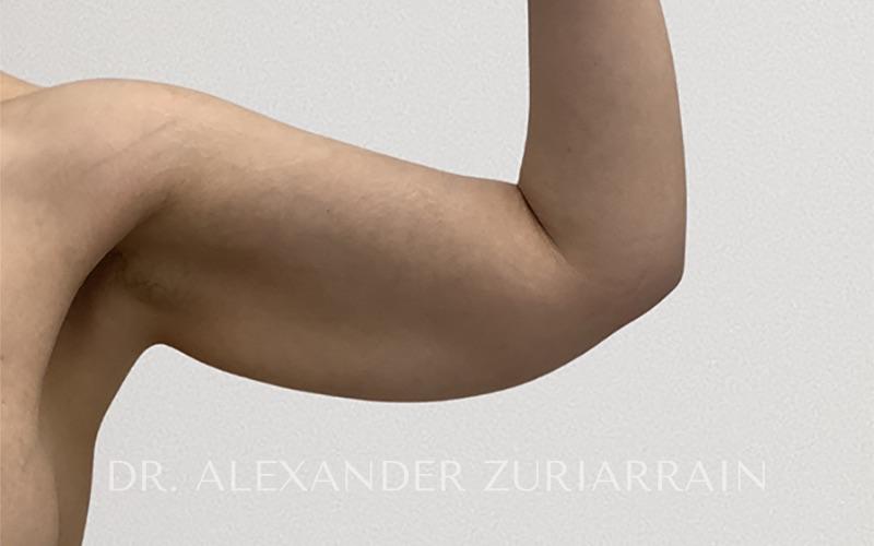 Arm liposuction before & after photo