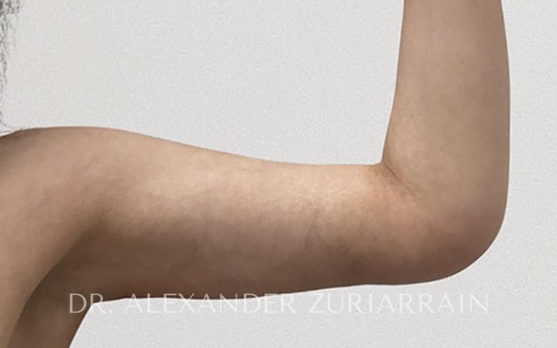 Arm liposuction before & after photo