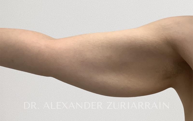 Arm liposuction before & after photo