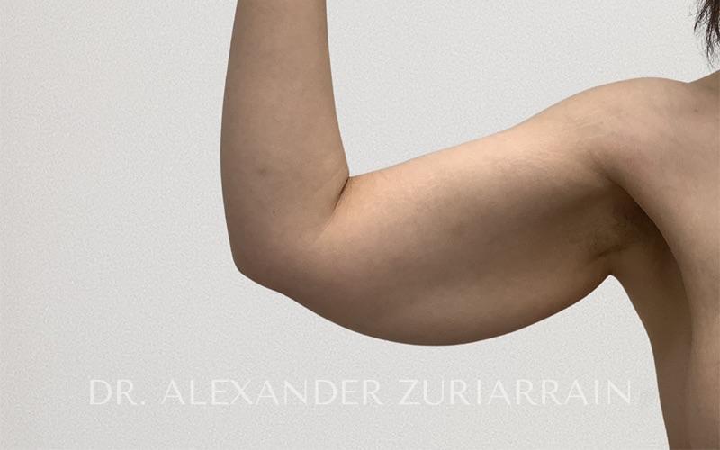 Arm liposuction before & after photo