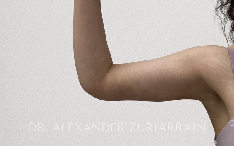 Arm liposuction before & after photo