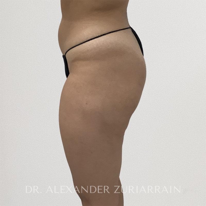 Aveli cellulite treatment before & after photo