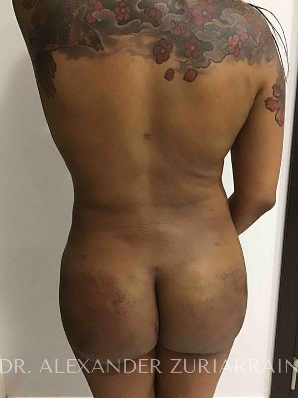 Brazilian butt lift before & after photo