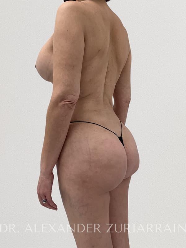 Brazilian butt lift before & after photo