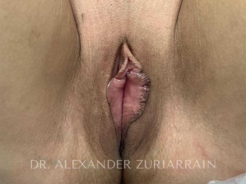 Labiaplasty before & after photo