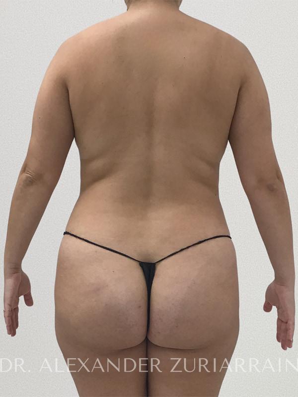 Liposuction before & after photo