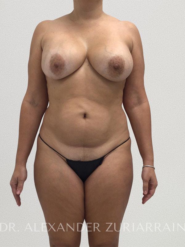 Tummy tuck before & after photo