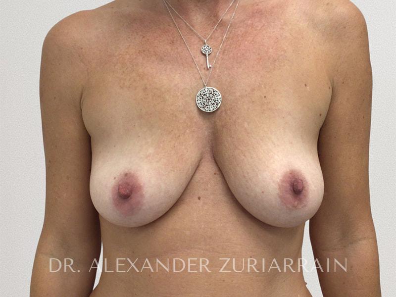 Breast augmentation before & after photo