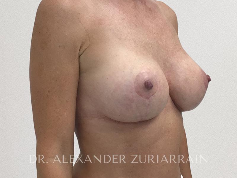 Breast augmentation before & after photo