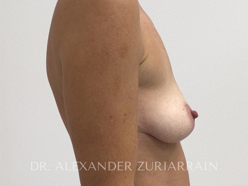 Breast augmentation before & after photo