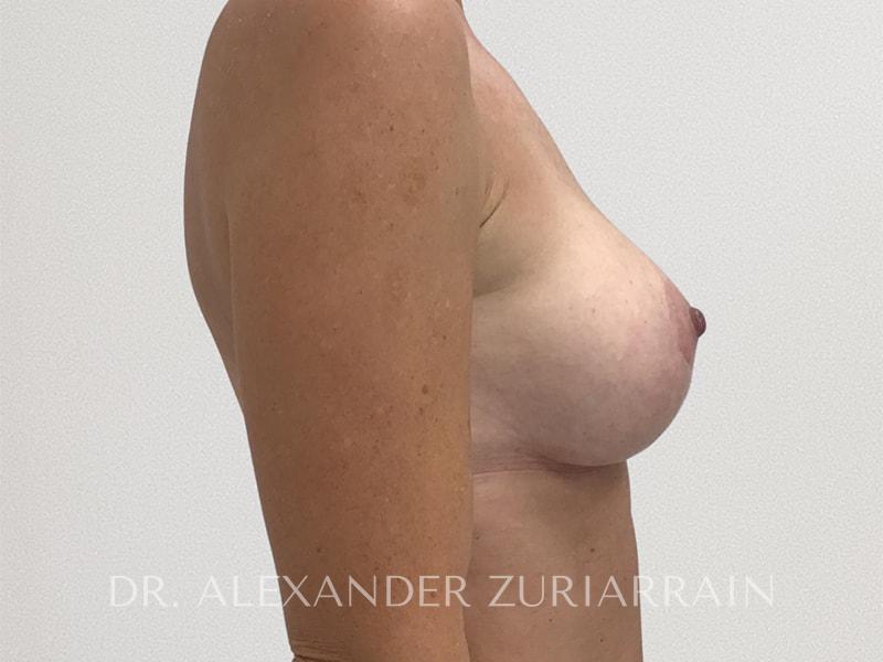 Breast augmentation before & after photo