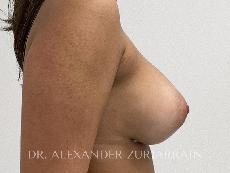 Breast augmentation before & after photo