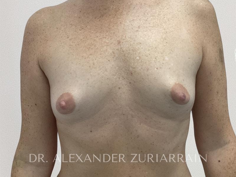 Breast augmentation before & after photo