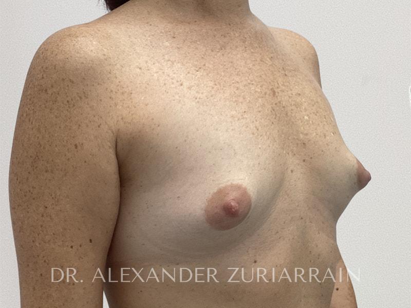 Breast augmentation before & after photo