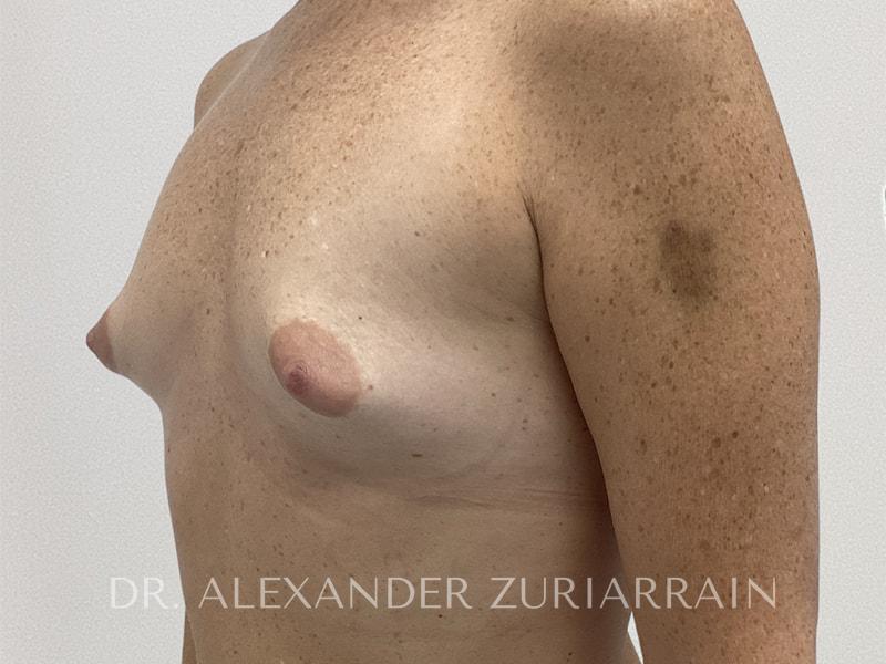 Breast augmentation before & after photo