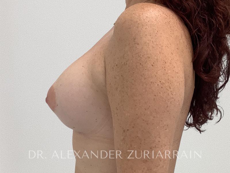 Breast augmentation before & after photo