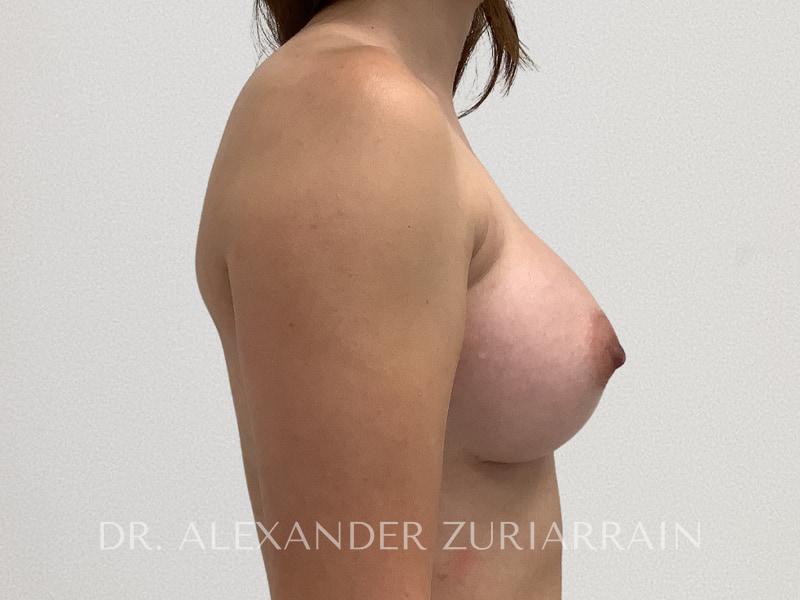 Breast augmentation before & after photo