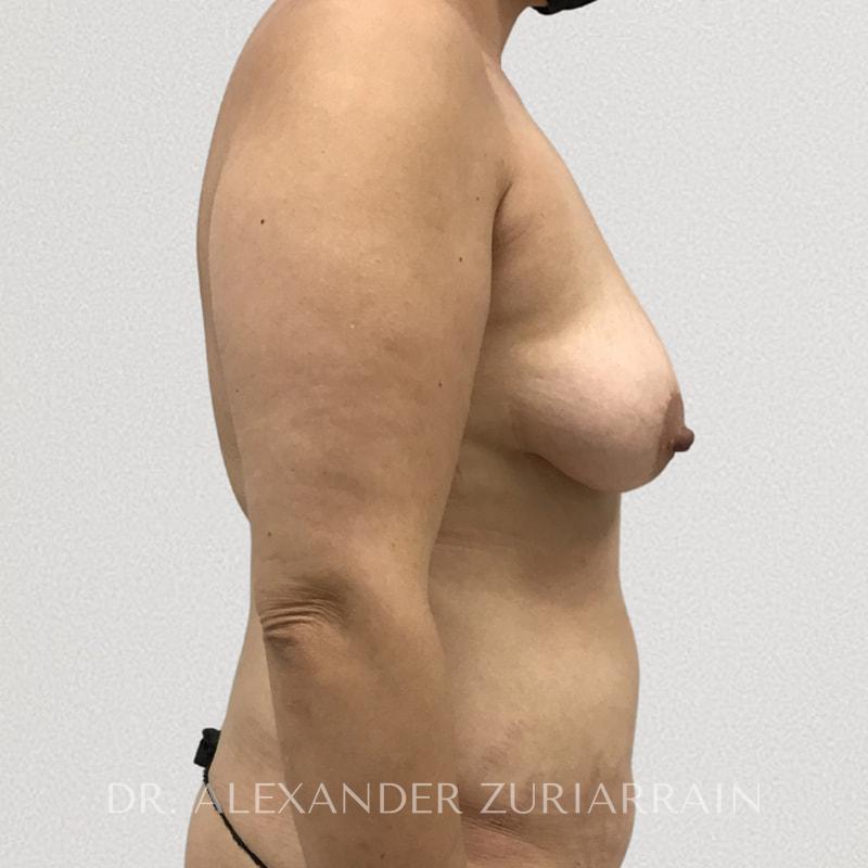 Breast augmentation with lift before & after photo