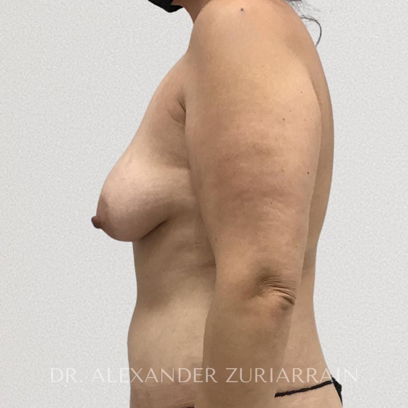 Breast augmentation with lift before & after photo