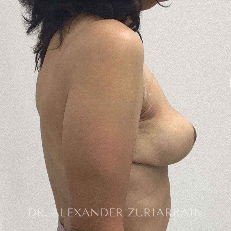 Breast implant removal with lift before & after photo