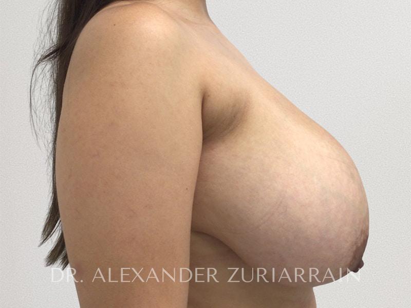 Breast lift before & after photo