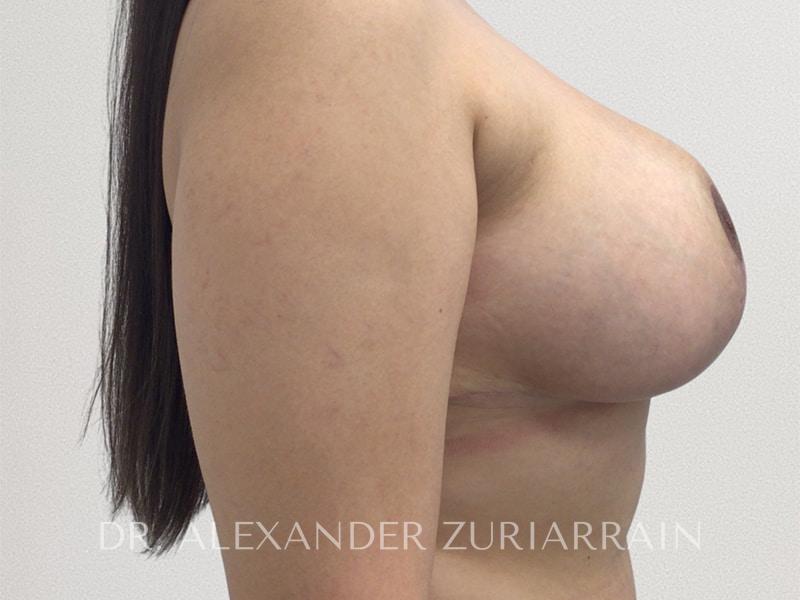 Breast lift before & after photo