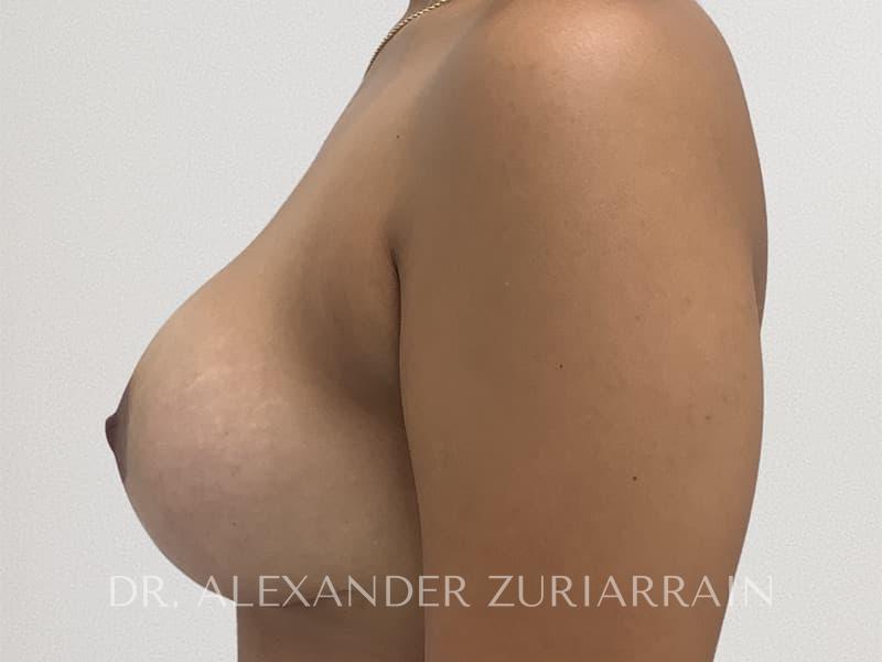 Breast lift before & after photo