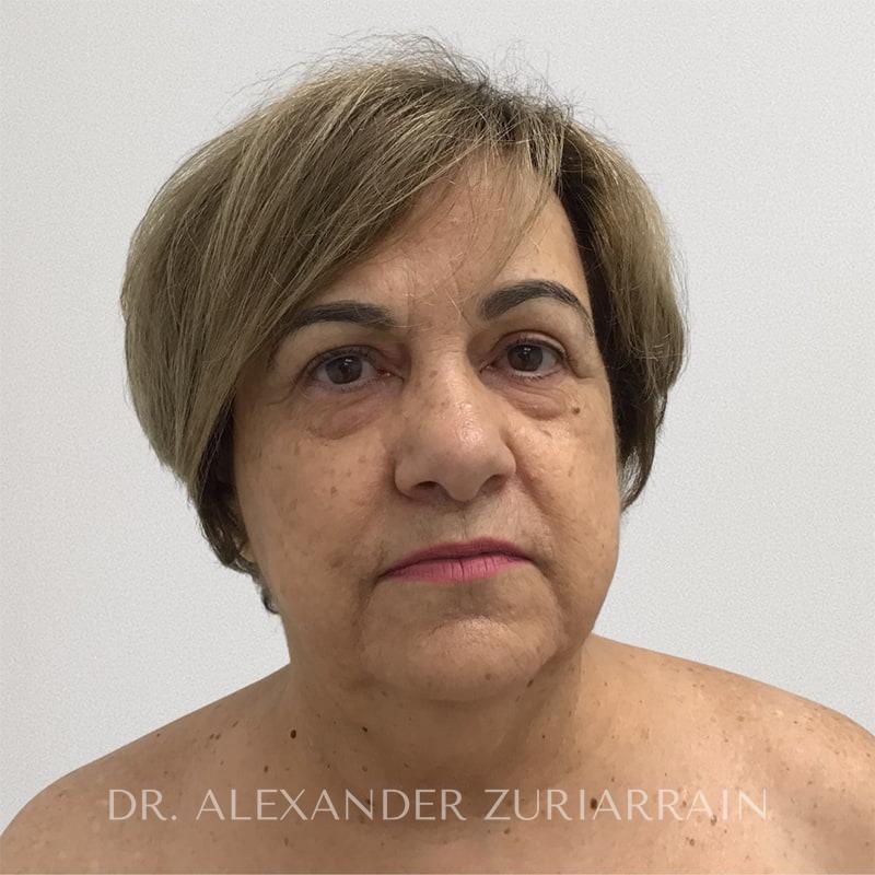 Blepharoplasty before & after photo