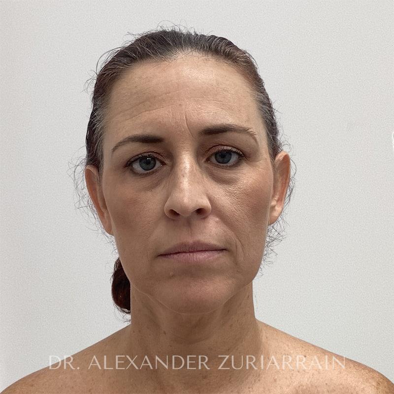 Blepharoplasty before & after photo