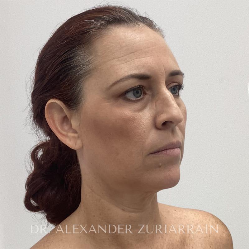 Blepharoplasty before & after photo