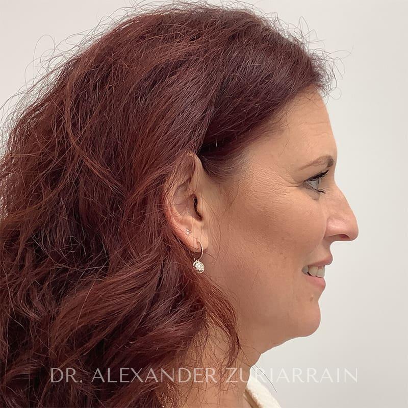 Blepharoplasty before & after photo