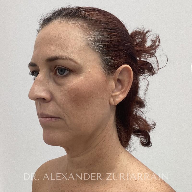 Blepharoplasty before & after photo