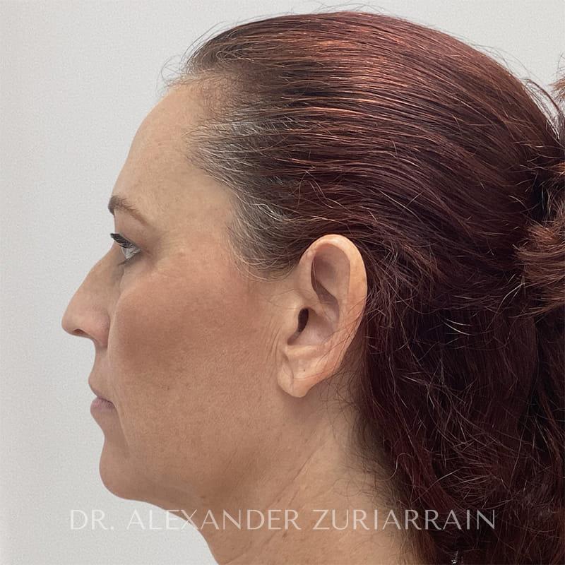 Blepharoplasty before & after photo