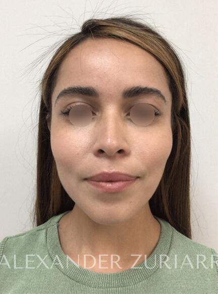 Buccal Fat Pad Removal - American Board of Facial Cosmetic Surgery