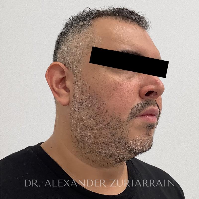 Chin implant before & after photo